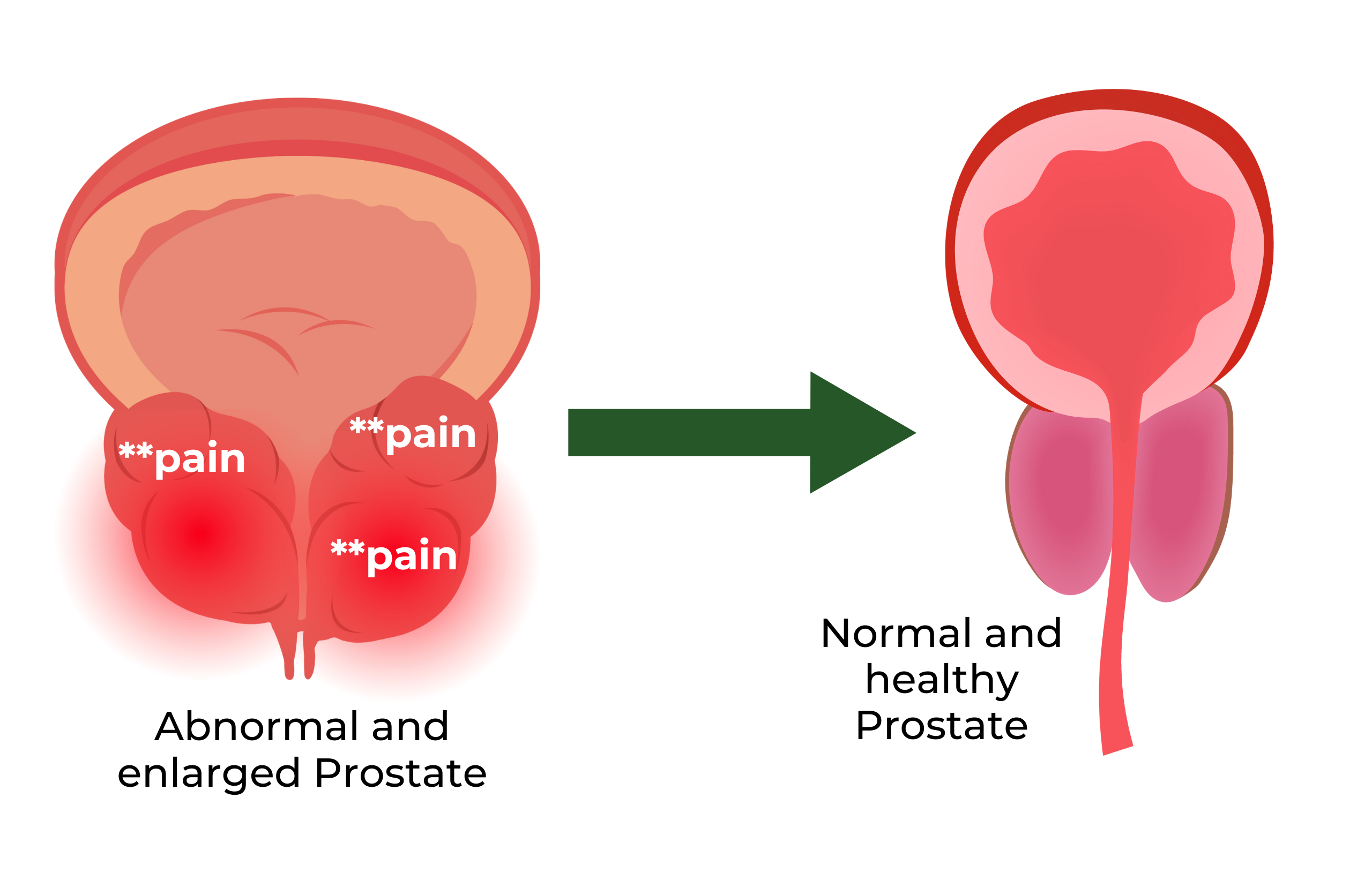 After Using Prosma Herbal Capsules